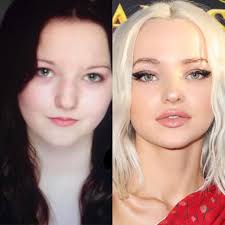 How to change your nose shape. Fixing Your Nose Shape With Non Surgical Nose Job