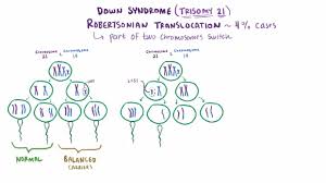 Down Syndrome Trisomy 21 Pediatrics Merck Manuals