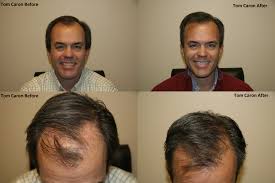 Energy star rebates are available. Nesn Tv Personality Tom Caron Hair Transplant
