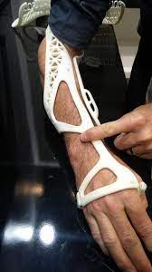 The First Patient To Ever Have A Shower With A 3d Printed Cast On A Broken Arm Digitalhealth 3dprinting 3d Printing Business 3d Printer 3d Printing