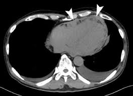 Flemming p, becker t, klempnauer j, hogemann d, kreft a, kreipe hh (2002) benign cystic mesothelioma of the liver. Imaging Findings Of A Case Of Intravascular Large B Cell Lymphoma With Cardiac Involvement Sciencedirect