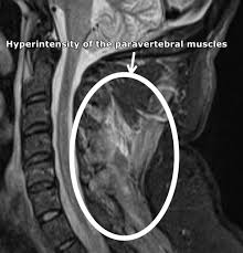 Image result for Polymyositis