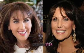 Robin Mcgraw Plastic Surgery Rumors Robin Mcgraw Plastic Surgery Plastic Surgery Celebrity Plastic Surgery