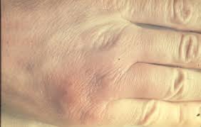 Image result for Erysipeloid