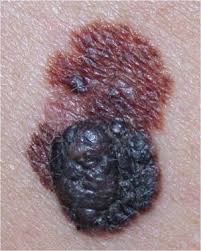 Resultado de imagen de imagenes de piel melanoma