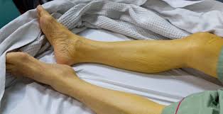 Jaundice Could Be More Serious Than You Think Dr Axe It is also known as jaundice berry and is often recommended to people suffering from jaundice. jaundice could be more serious than you