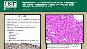 Hepatocellular Carcinoma With Small Cell Histology A Rare