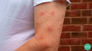 Image result for mosquito bite