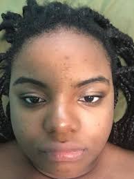 Eyeglass accessories, eyeglass retainers, eyeglass socks, eyeglass jewelry that prevent eyeglass pressure, nose dents, and keeps glasses from slipping. Can Glasses Cause Permanent Dent In One Side Of The Nose Photos