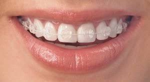 Eine zahnspange ist ein medizinisches hilfsmittel, mit dem fehlstellungen von zähnen und kiefer korrigiert werden können. Zahnspange Kosten Preise Turkei Istanbul Mit Partnerklinik In Zurich
