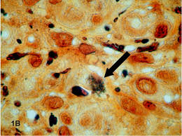 Que es exacto o conforme a la. Bartonella Quintana Wikipedia La Enciclopedia Libre