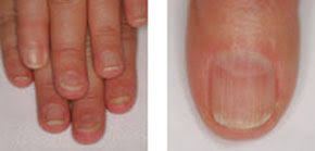 Nail Disorders And Systemic Disease What The Nails Tell Us