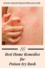 How To Get Rid Of Poison Ivy Rash Poison Ivy Remedies Poison Ivy Rash Poison Ivy Home Remedies