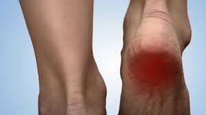 We did not find results for: Espolon Calcaneo Descripcion Del La Patologia Y Sus Causas