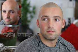 Why do people stare at your hairline?