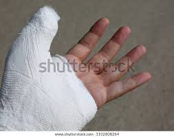 Image result for Hand Fracture