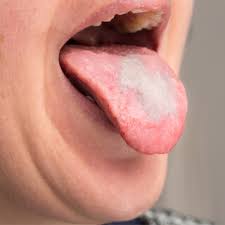 تعرف على أعراض الإيدز بالصور ويب طب