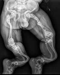 RayosPedia® | La osteogenesis imperfecta (OI) es un grupo de trastornos del  tejido conectivo que genera anomalías esqueléticas caracterizadas por... |  Instagram