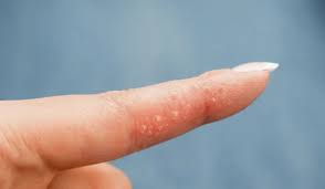 Image result for dyshidrosis