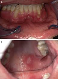How syphilis changed the face of medical research. Oral Syphilis A Series Of 5 Cases Journal Of Oral And Maxillofacial Surgery