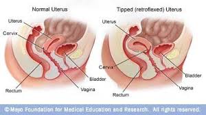 A Tale Of My Tilted Uterus Mother Rising Retroverted Uterus Uterus Getting Pregnant