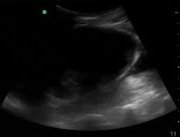 Image result for Perinephric Abscess