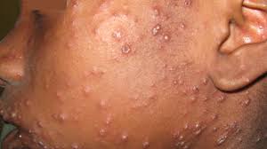 Image result for measles