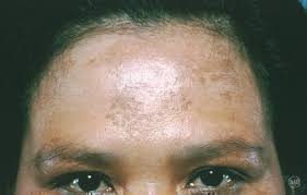 Image result for Melasma