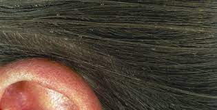 Head Lice Health Information Bupa Uk