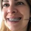 Ho i denti superiori davanti lievemente separati, piuttosto giallini ed anche un p consumati, insomma la mia dentista mi ha proposto di di rivestirli con sottilissime mascherine, mi ha mostrato anche il. 1