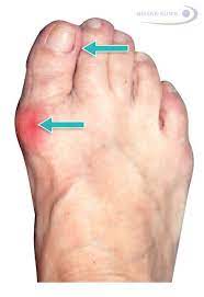 Dabei gibt es schienen, welche die patienten entweder am tag oder über nacht (als nachtschiene) tragen müssen. Hallux Valgus Operation Korrektur Der Stellung Der Grosszehe Gelenk Klinik De