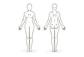 Las personas con fibromialgia pueden ser más sensibles al dolor que aquellas que no la tienen. Que Son Los Puntos Dolorosos En Fibromialgia Fibromialgia Sevilla