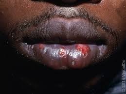 Image result for oral herpes symptoms roof of the mouth