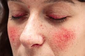 Seborrhoeic dermatitis of the eyelids tends to affect just the eyelid margins and is seen more frequently in adults. Eyelid Dermatitis All About Vision
