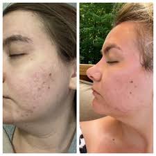 Rodan Fields skincare product results