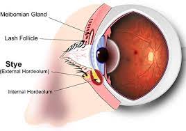 Eye Stye Removal Treatment Top Eye Doctor Ophthalmologist Nyc