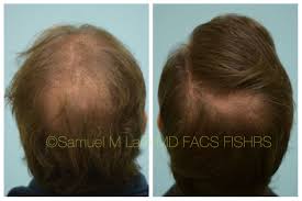 This 45 Year Old Man Is Shown Before And 5 Months After Hair Transplant Hair Restoration Hair Transplant Results Hair Transplant