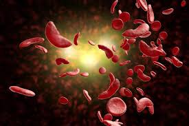 What is sickle cell anemia? Challenges Of Developing And Facilitating Access To New Sickle Cell Disease Therapies Case Of The Deferoxamine Patch