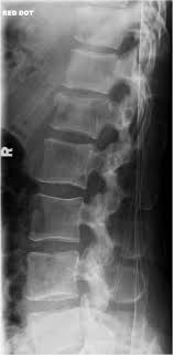 The doctor suggested bracing for three. The Thoracolumbar Spine