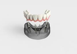 Avoid hard or extra crunchy foods until you are more comfortable chewing. Keep Your Dentures In Your Mouth With Implant Supported Dentures Smiles By Design Pc Huntsville Alabama