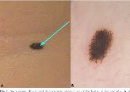 Image result for Spitz Nevus