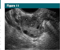 Image result for corpus luteum sonography)