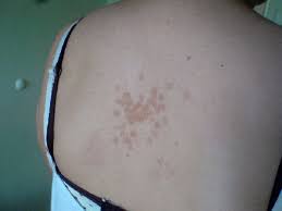 Pityriasis lichenoides et varioliformis acuta is a disease of the immune system. Tinea Versicolor Knowledge Amboss