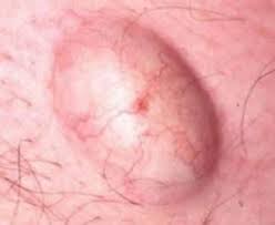 Ingrown hairs do not usually require treatment ingrown hairs are most common in people with very curly hair. Ingrown Hair Lump Under Skin Drone Fest