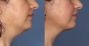 How much does a kybella treatment cost? Kybella Seattle Kybella Injection For Chin Fat Kybella Fat Treatment