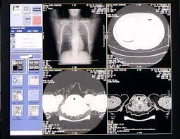 Ct imaging of rapid progression stage. How Alibaba Damo Academy Ai System Detects Coronavirus Cases Alibaba Cloud Community