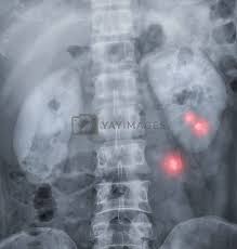 Image result for Intravenous Pyelogram