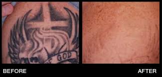 Early registration rate of $995 lasts until january 25, 2020. Laser Tattoo Removal Miami Tattoo Removal Hollywood Pembroke Pines