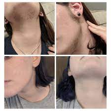 #male pubic laser hair removal before and after image or laser pubic. Before And After Groupon For Laser Hair Removal Has Changed My Life Hairremoval