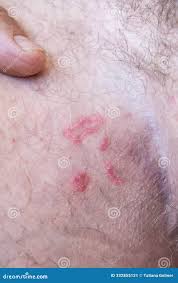 Image result for sore skin in the groin area